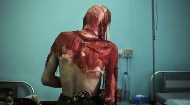 مرصد دولي:#الحـوثيون يمارسون عمليات تعذيب ممنهجة ضد المعتقلين في سجونهم
