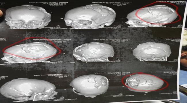 على نفقة الامارات ..نجاح عملية جراحية كبرى في #مصـر للجريح شريف مثنى