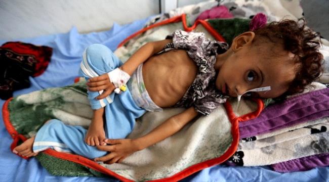 اليمن يسجل أعلى مستويات سوء التغذية بين الأطفال في العالم 
