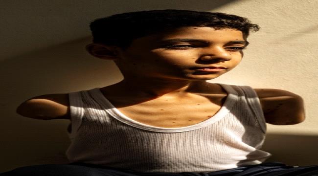 "كيف سأعانقك بلا ذراعين؟".. صورة طفل فلسطيني في غزة تفوز بجائزة عالمية