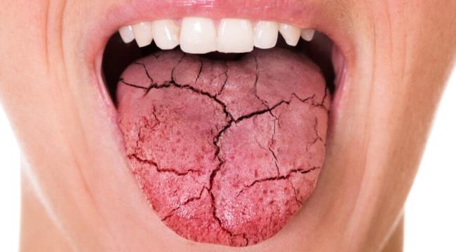 أمل جديد لمرضى جفاف الفم.. علاج صيني يعيد إفراز اللعاب